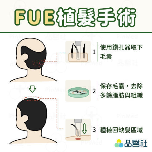 植髮_FUE植髮手術