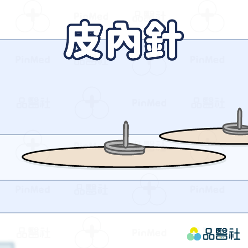 針灸原理_皮內針