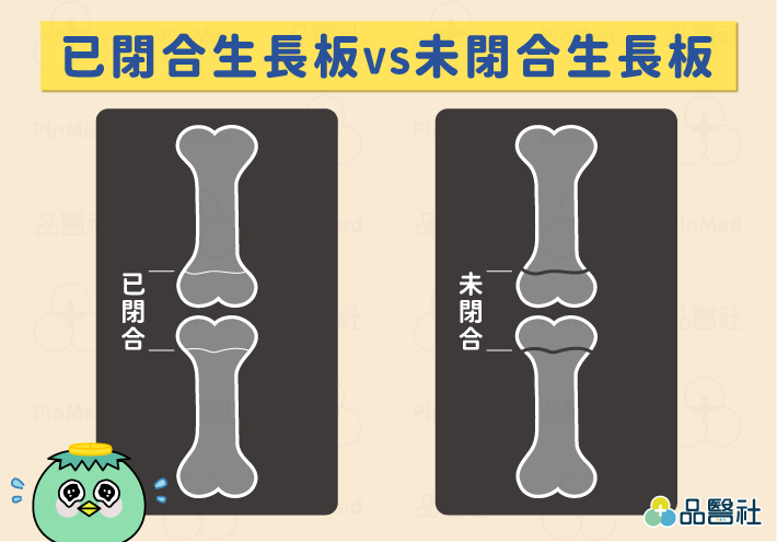 長高_已閉合生長板VS未閉合生長板