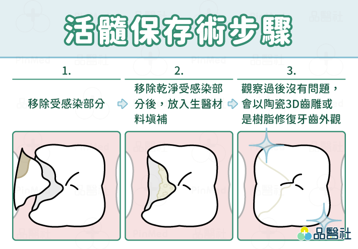 活髓保存術步驟