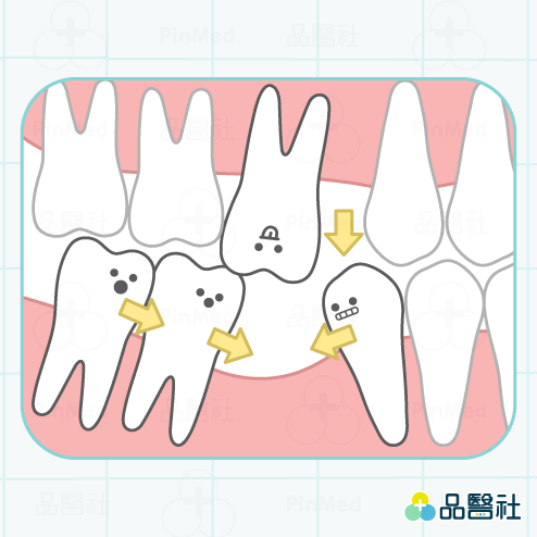 缺牙怎麼辦_牙齒移位
