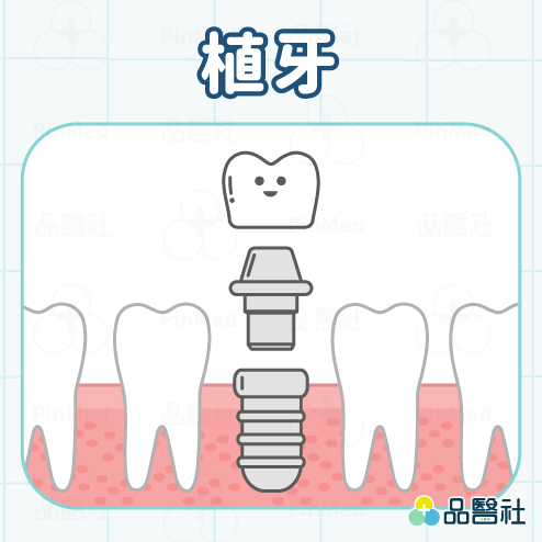 缺牙怎麼辦_植牙