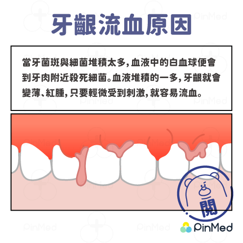 牙齦出血_牙齦出血原因