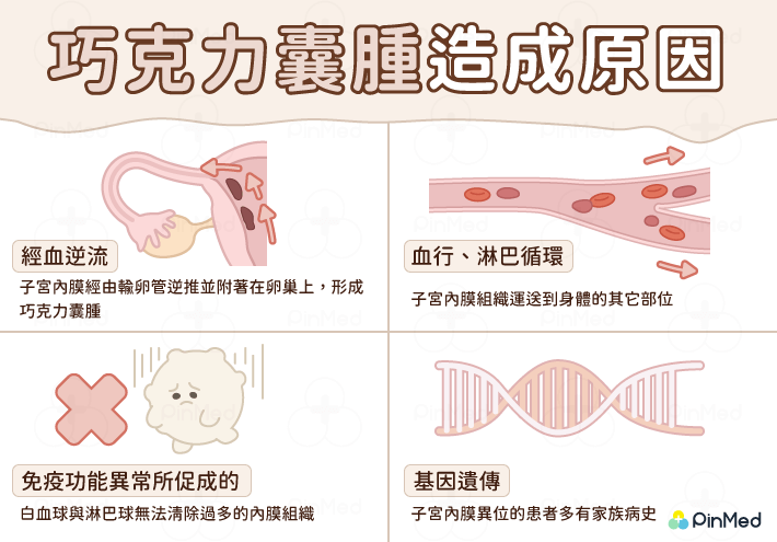 巧克力囊腫造成原因