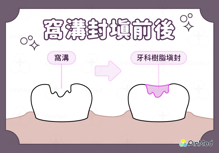 窩溝封填_窩溝封填前後