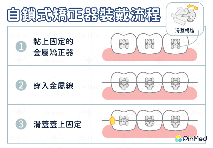 自鎖式矯正器_自鎖式矯正器裝戴流程