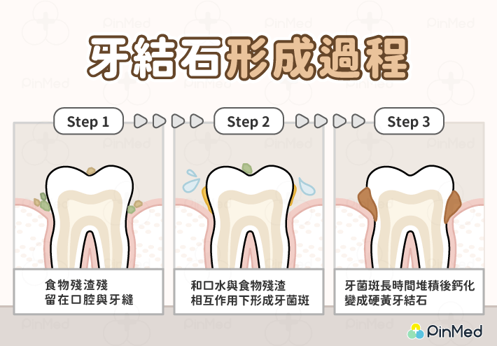 牙結石