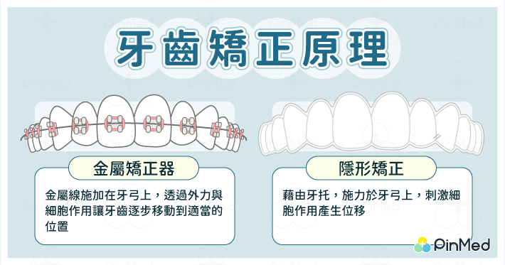 牙齒矯正_牙齒矯正原理
