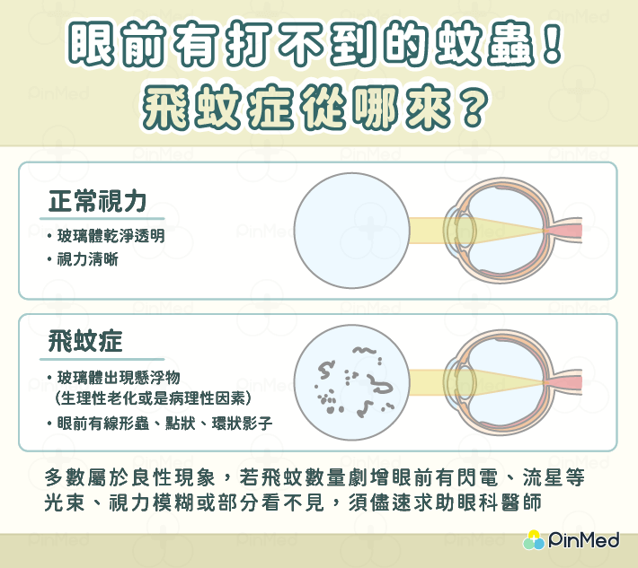 飛蚊症改善方法與原理