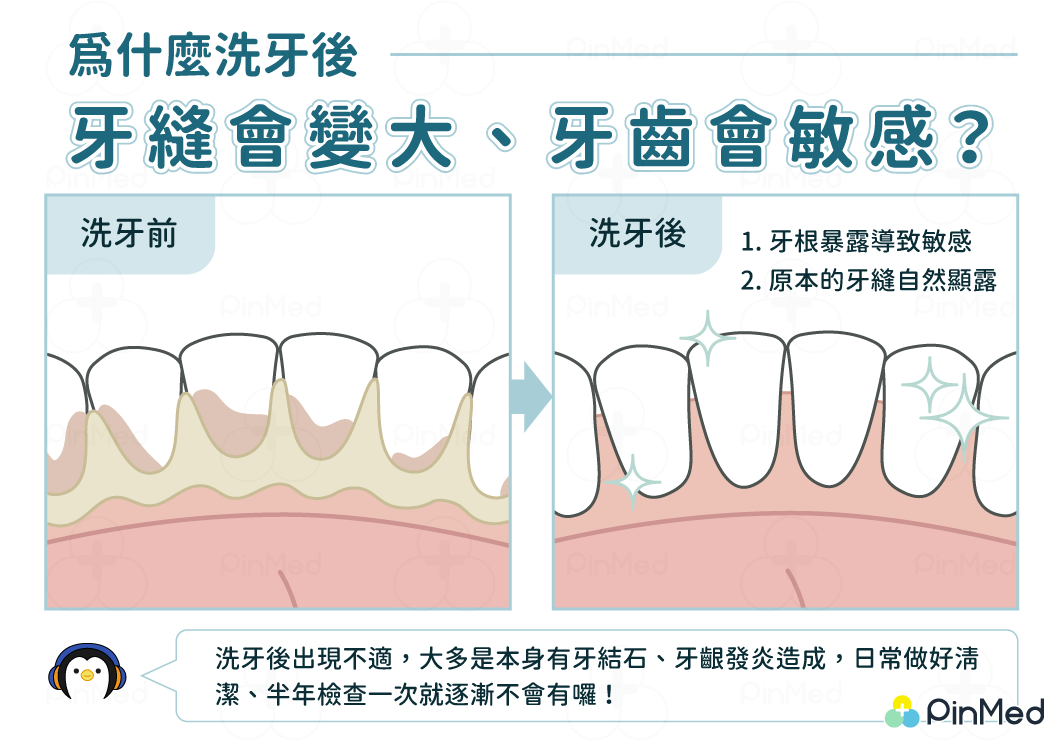 為何洗牙後牙縫變大、牙齒敏感？一解洗牙後遺症迷思原來不是醫師的錯！ - Pinmed