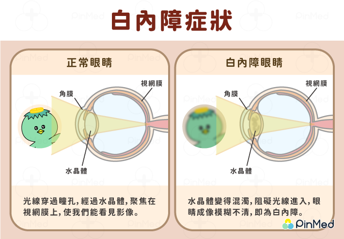 白內障_白內障症狀