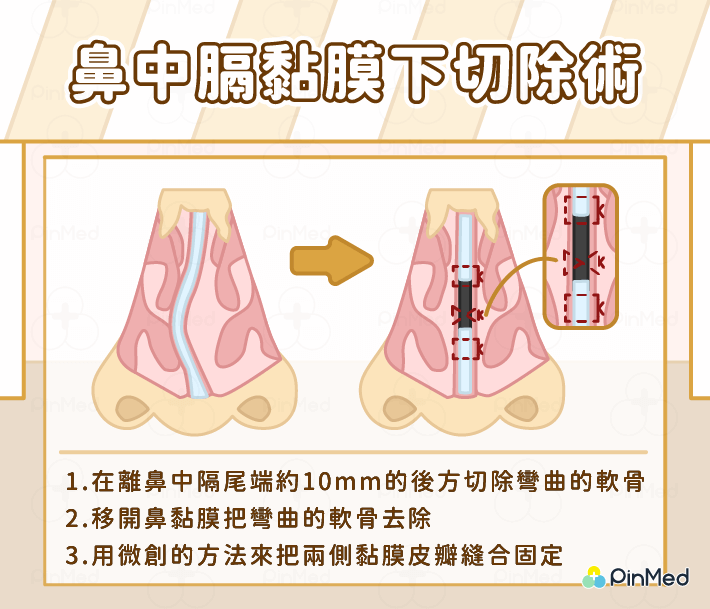 鼻中膈彎曲