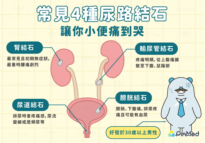 尿路結石