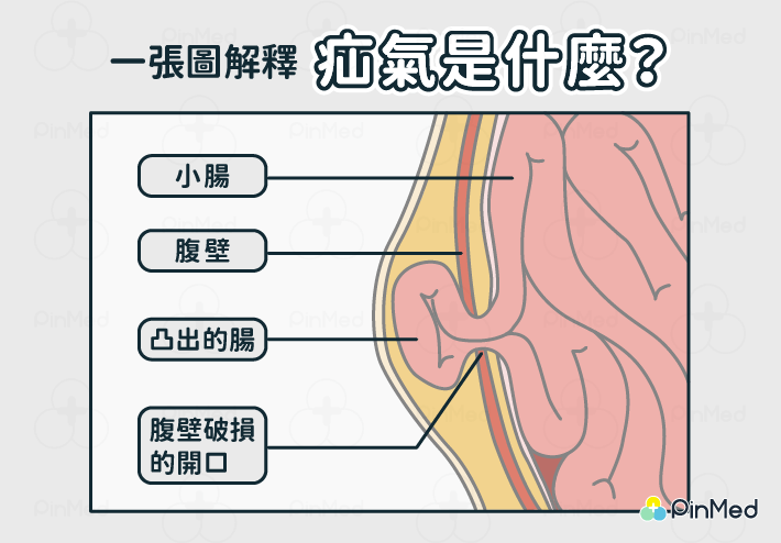 什麼是疝氣