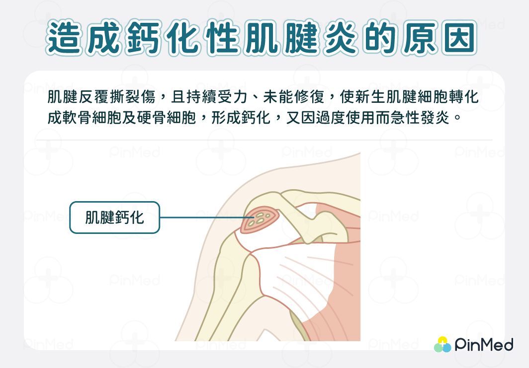 鈣化性肌腱炎_原因