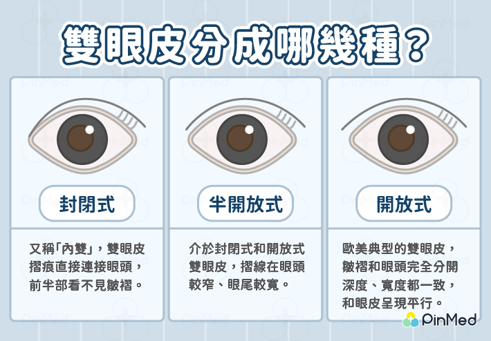 雙眼皮手術-雙眼皮類型