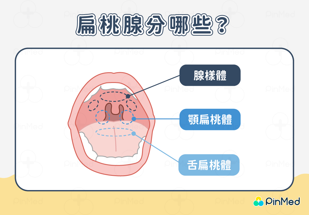 扁桃腺發炎