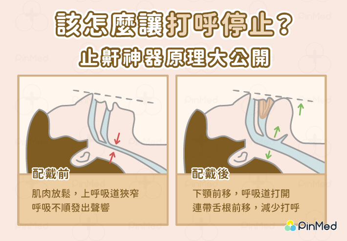 止鼾器_原理