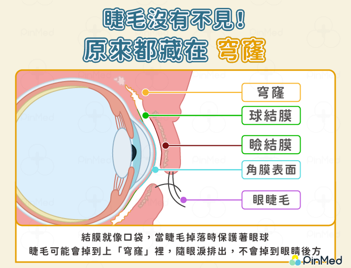 睫毛掉進眼睛