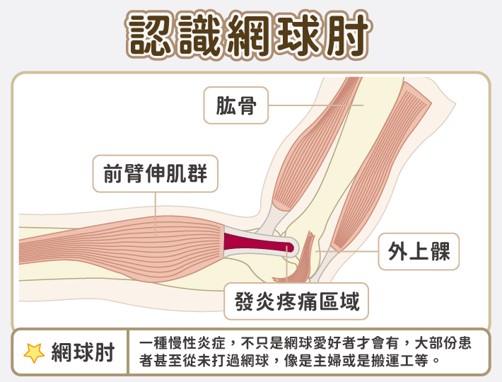 網球肘