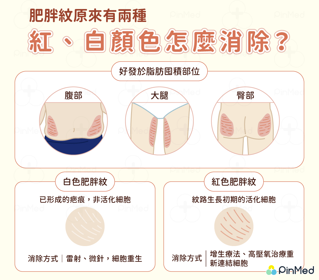 肥胖紋