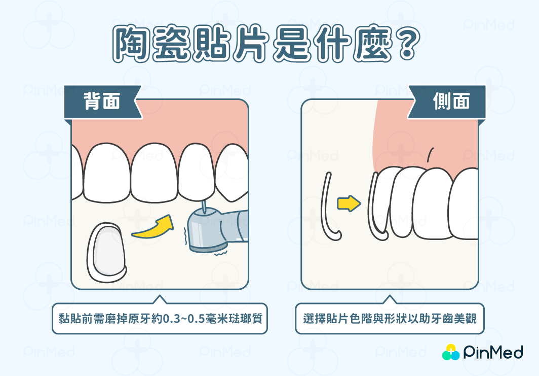 陶瓷貼片是什麼