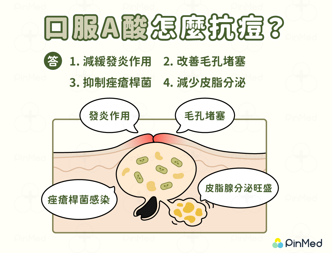 口服A酸-如何抗痘 口服A酸-如何抗痘