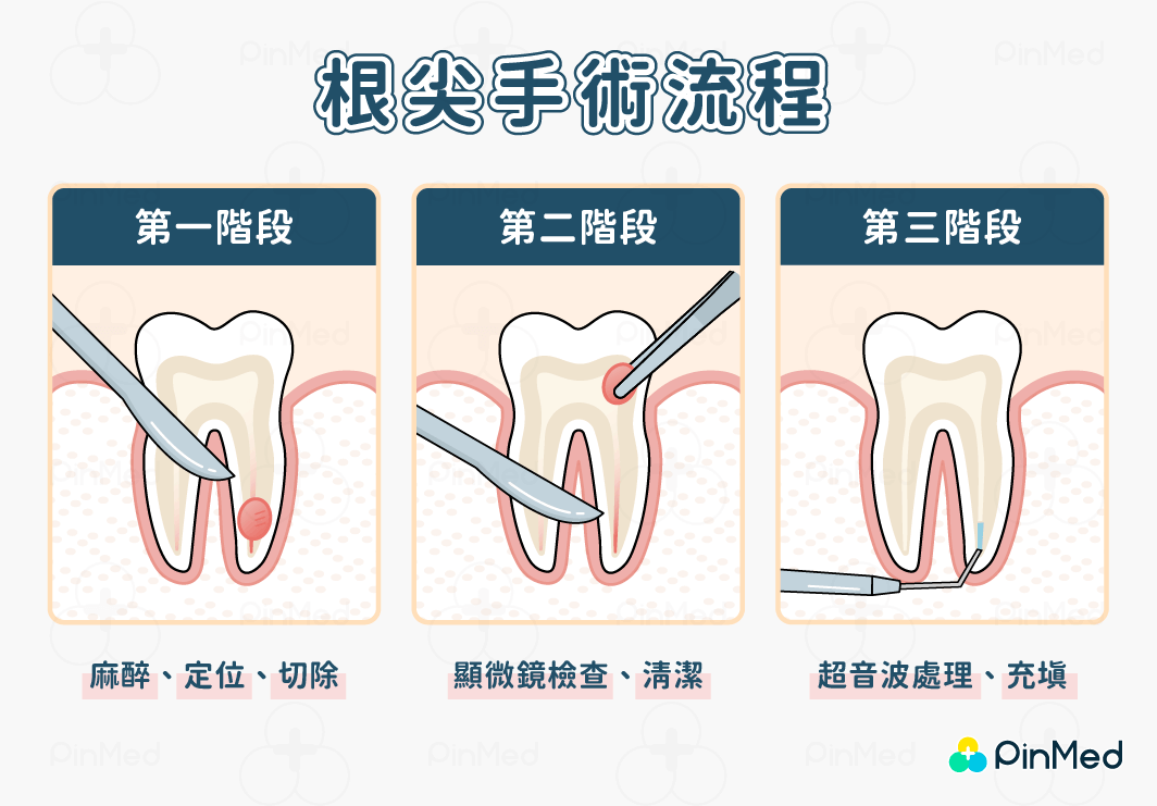 根尖手術