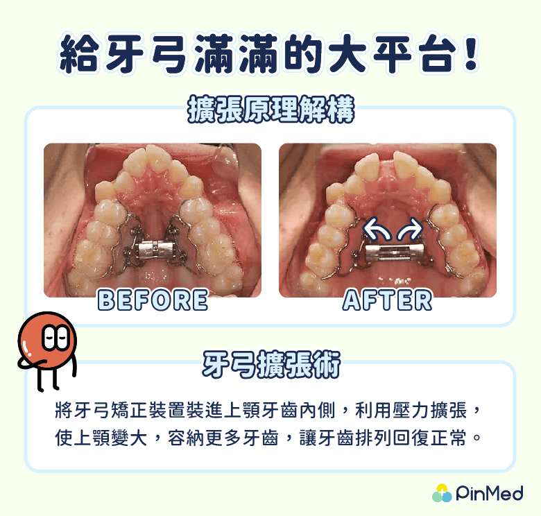 牙弓擴張