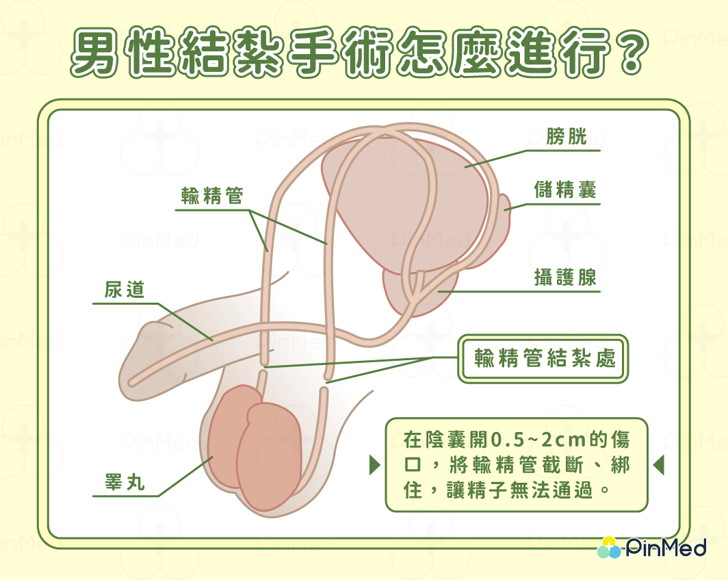 男性結紮_怎麼做