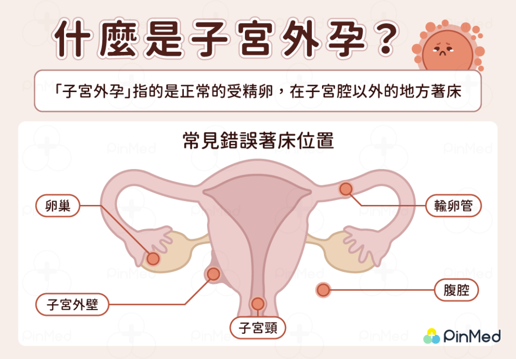 子宮外孕_是什麼