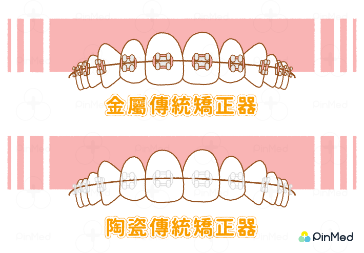 牙齒矯正器_傳統矯正器 金屬 陶瓷