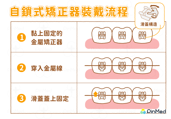 牙齒矯正器2_自鎖式矯正器裝戴流程