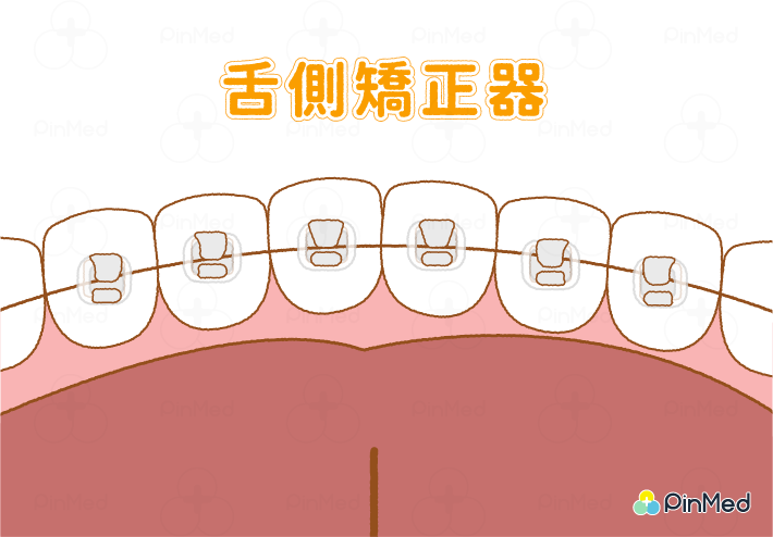 牙齒矯正器_舌側矯正器