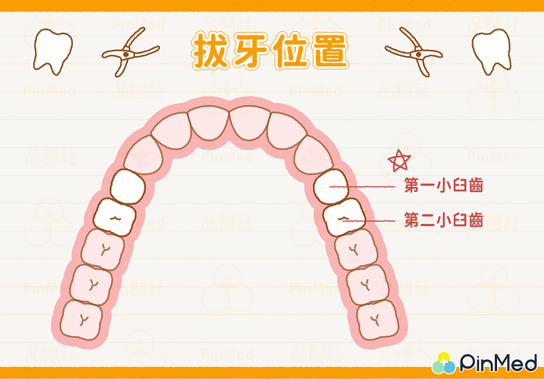 矯正拔牙