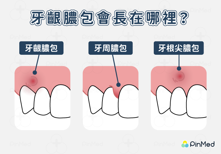 牙齦膿包