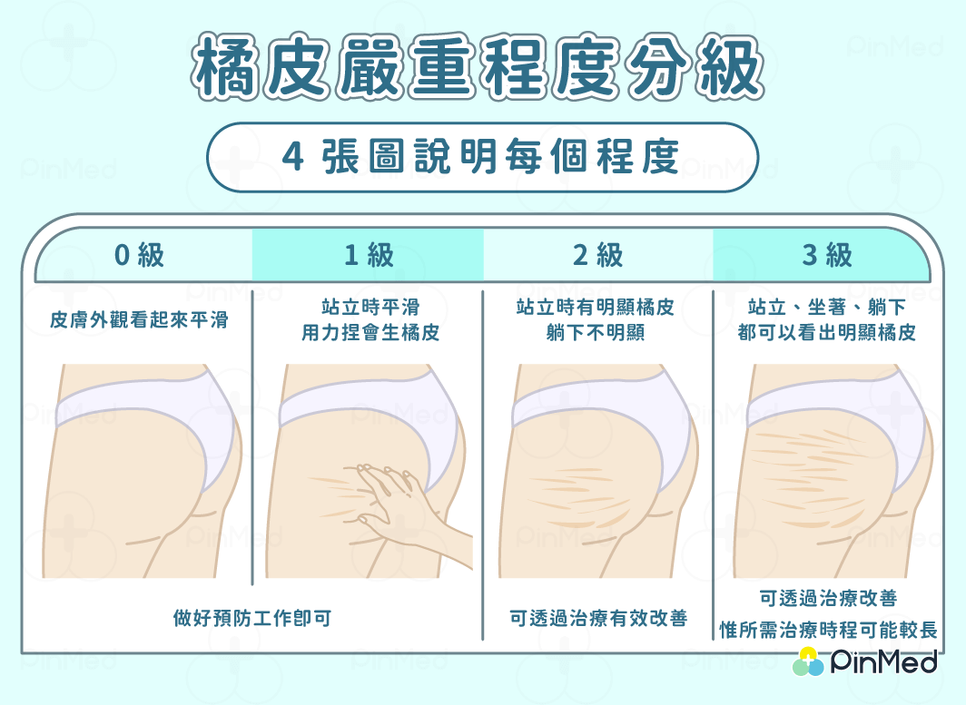 橘皮嚴重程度分級