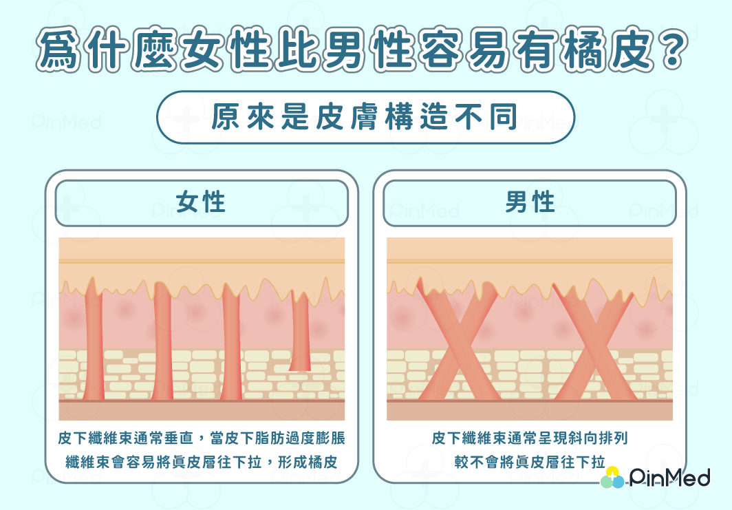 為什麼女性比男性容易有橘皮？