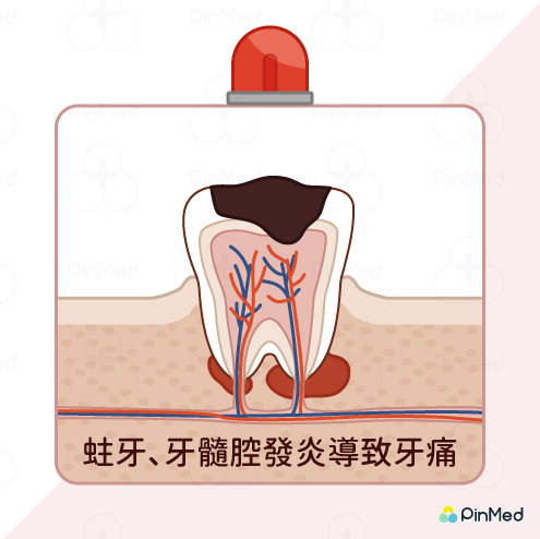 牙齒痛到睡不著！3種緊急解決牙痛妙方　吃了止痛藥還是痛要改看這一科