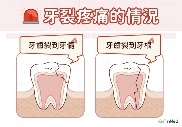 牙齒痛到睡不著！3種緊急解決牙痛妙方　吃了止痛藥還是痛要改看這一科