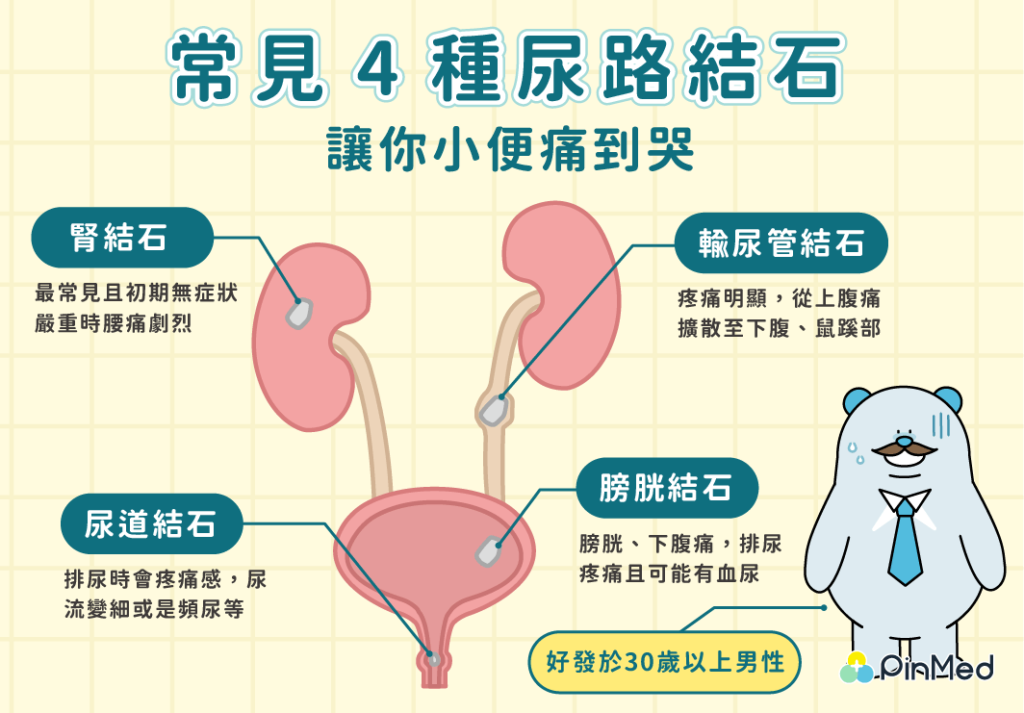 腎結石