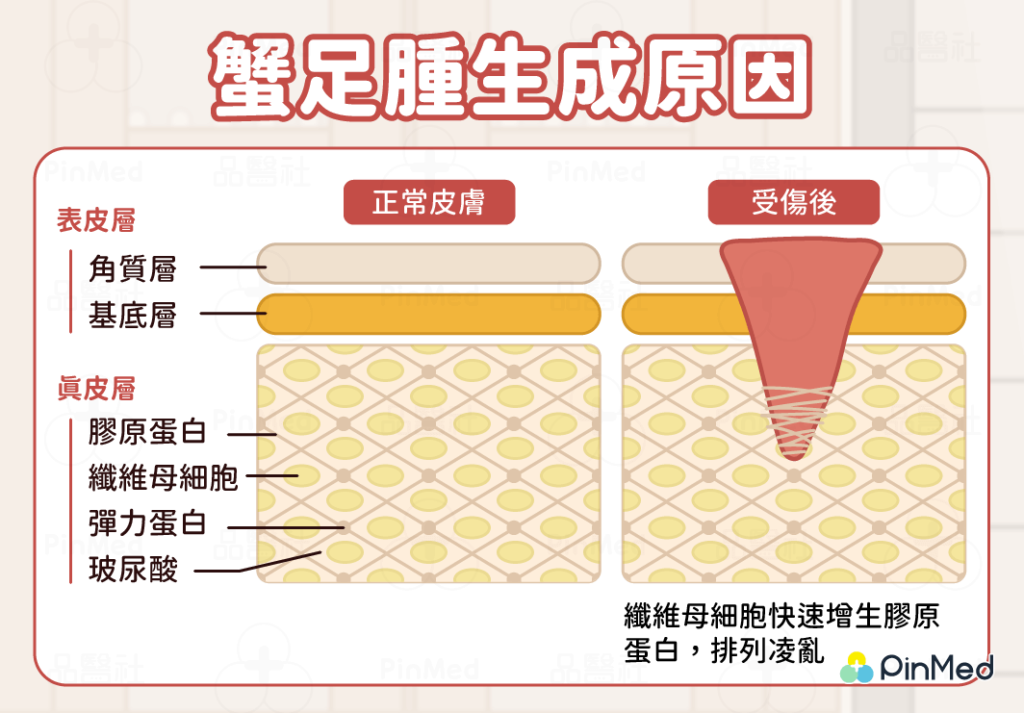 蟹足腫體質怎麼判斷？能打耳洞嗎？教你預防、6種治療方法！