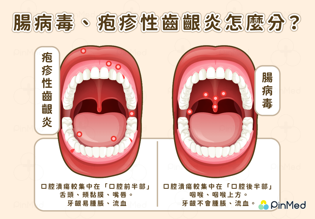 腸病毒、疱疹性齒齦炎怎麼分？