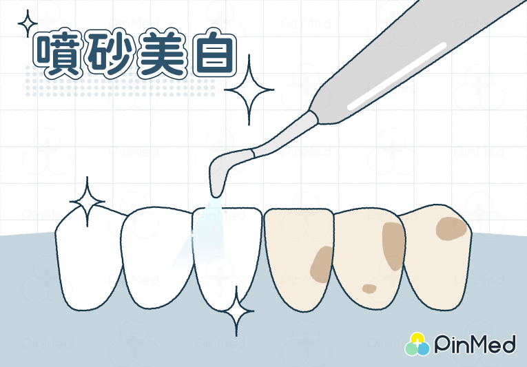 噴砂美白_原理