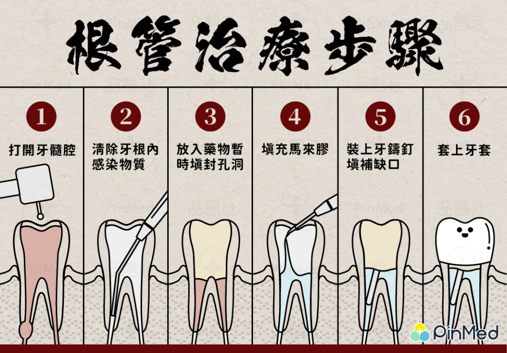 根管治療步驟