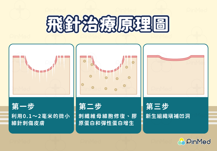 「飛針」是什麼？能讓凹疤扁平、緊緻回春　原理效果、後遺症一次看！