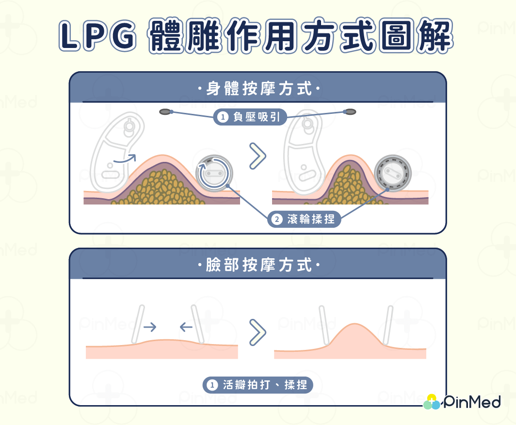 號稱躺著就能瘦，但治療完體重反而增加？破解LPG體雕真實效果、原理、價格