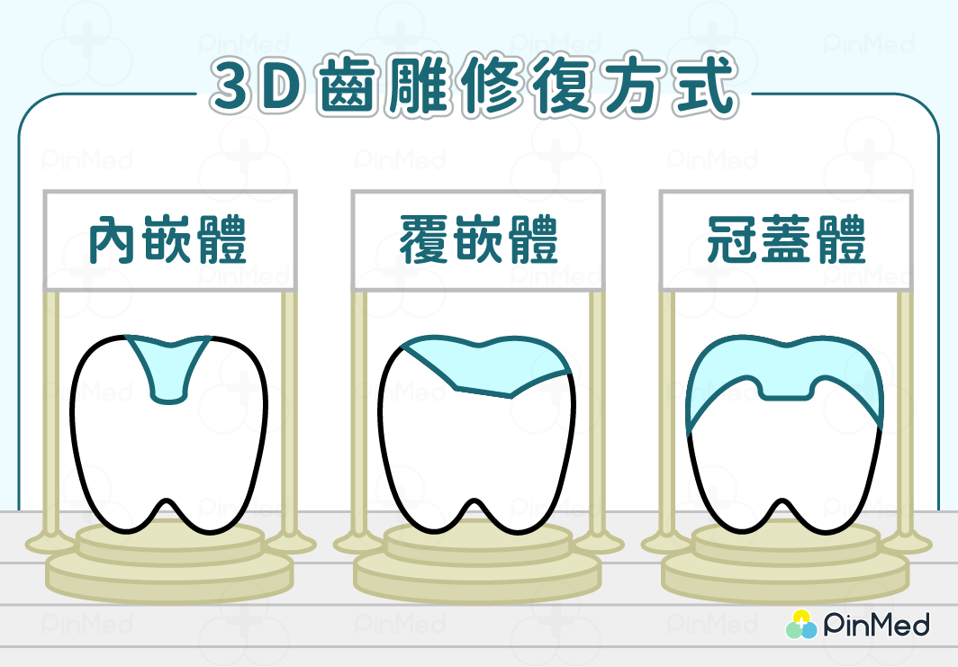 3D齒雕