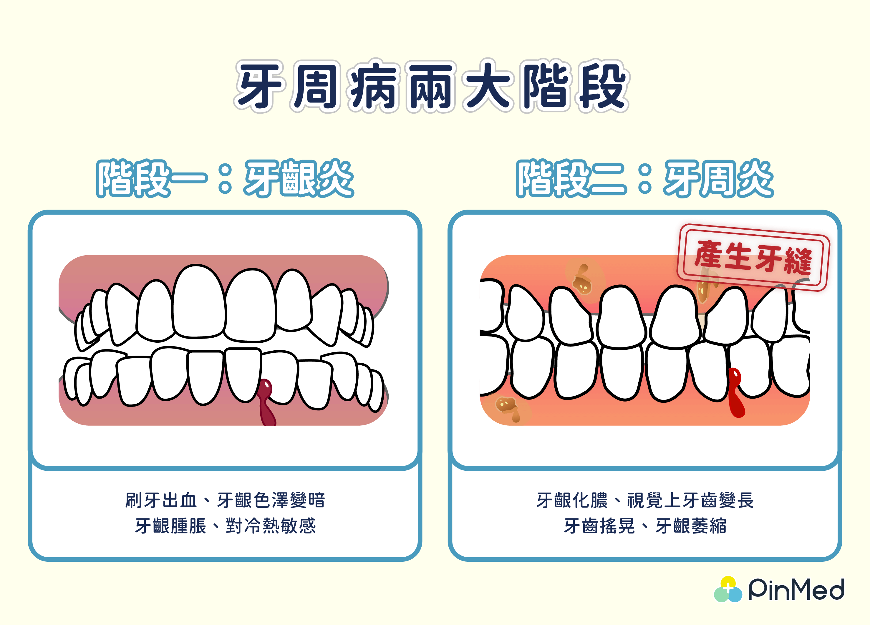 牙周病兩大階段