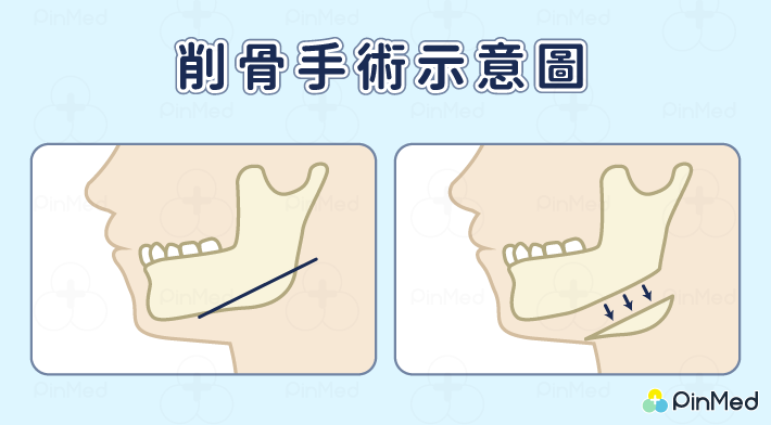 愛吃口香糖會變國字臉嗎？只能削骨改善？破解本壘板迷思